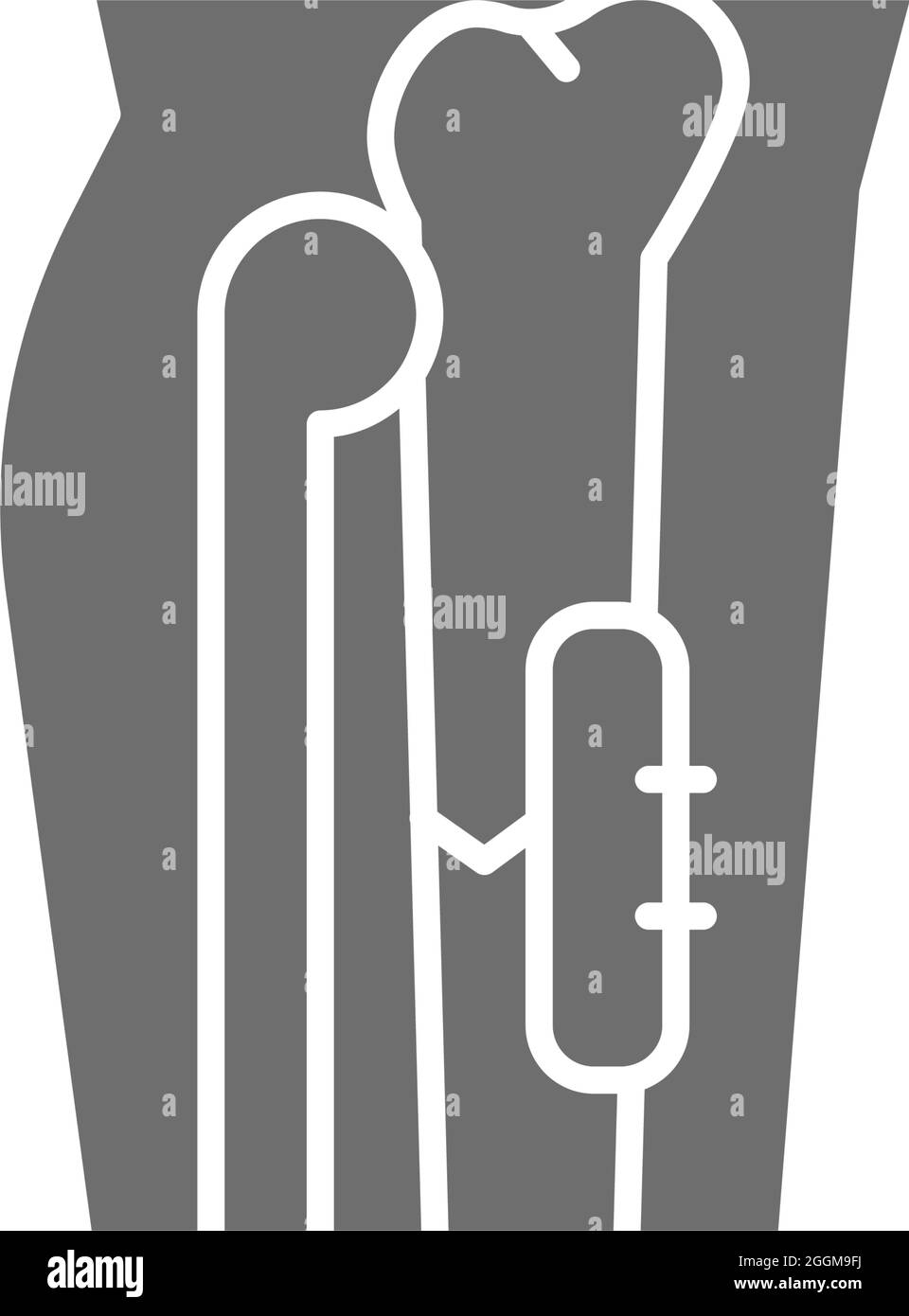 Rayons X de la jambe cassée, os fixé avec une plaque implantable médicale icône grise. Illustration de Vecteur