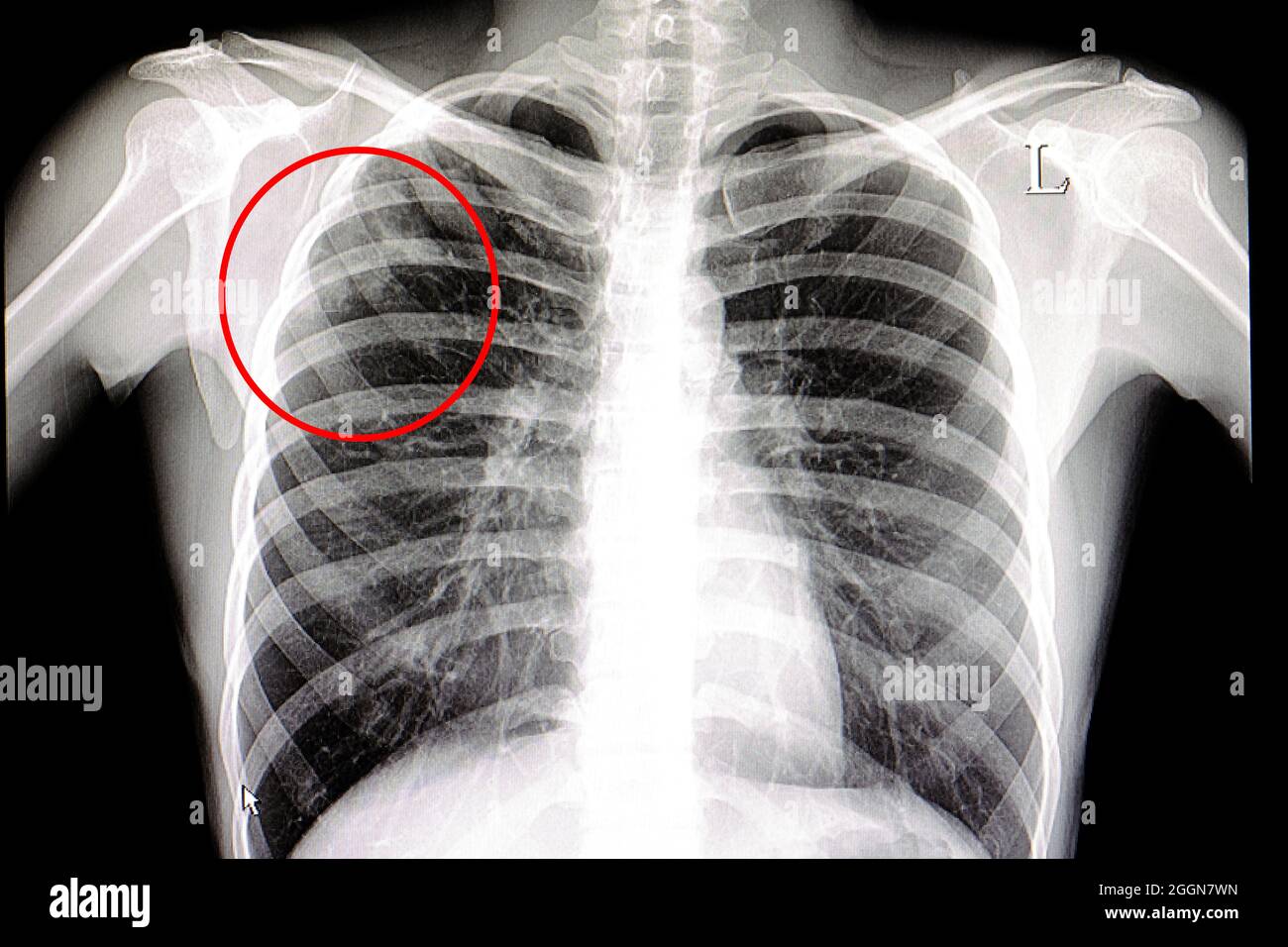Radiographie d'un patient atteint de tuberculose pulmonaire Photo Stock -  Alamy