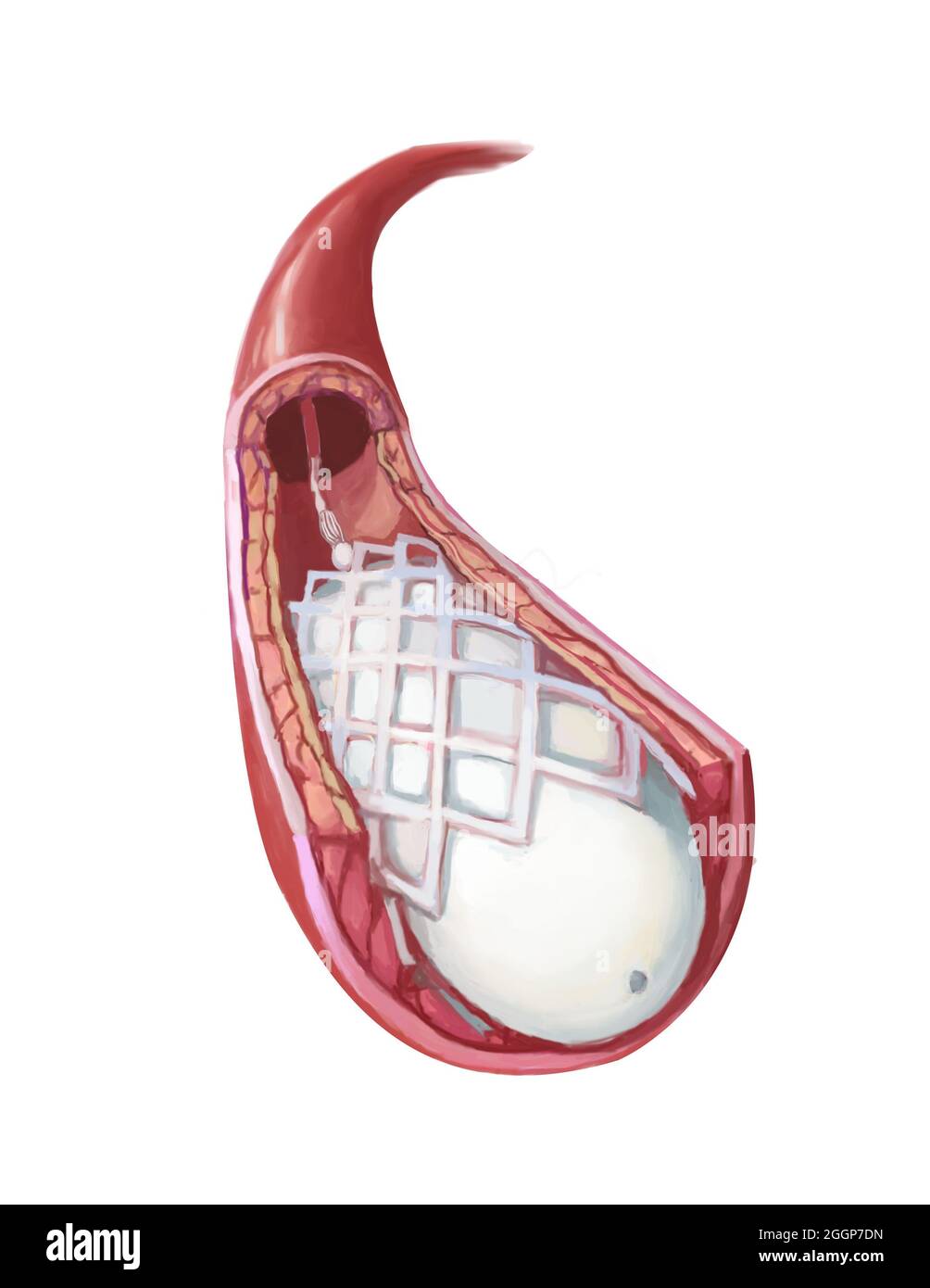 Illustration médicale montrant l'angioplastie par ballonnet et l'insertion d'un stent. Banque D'Images