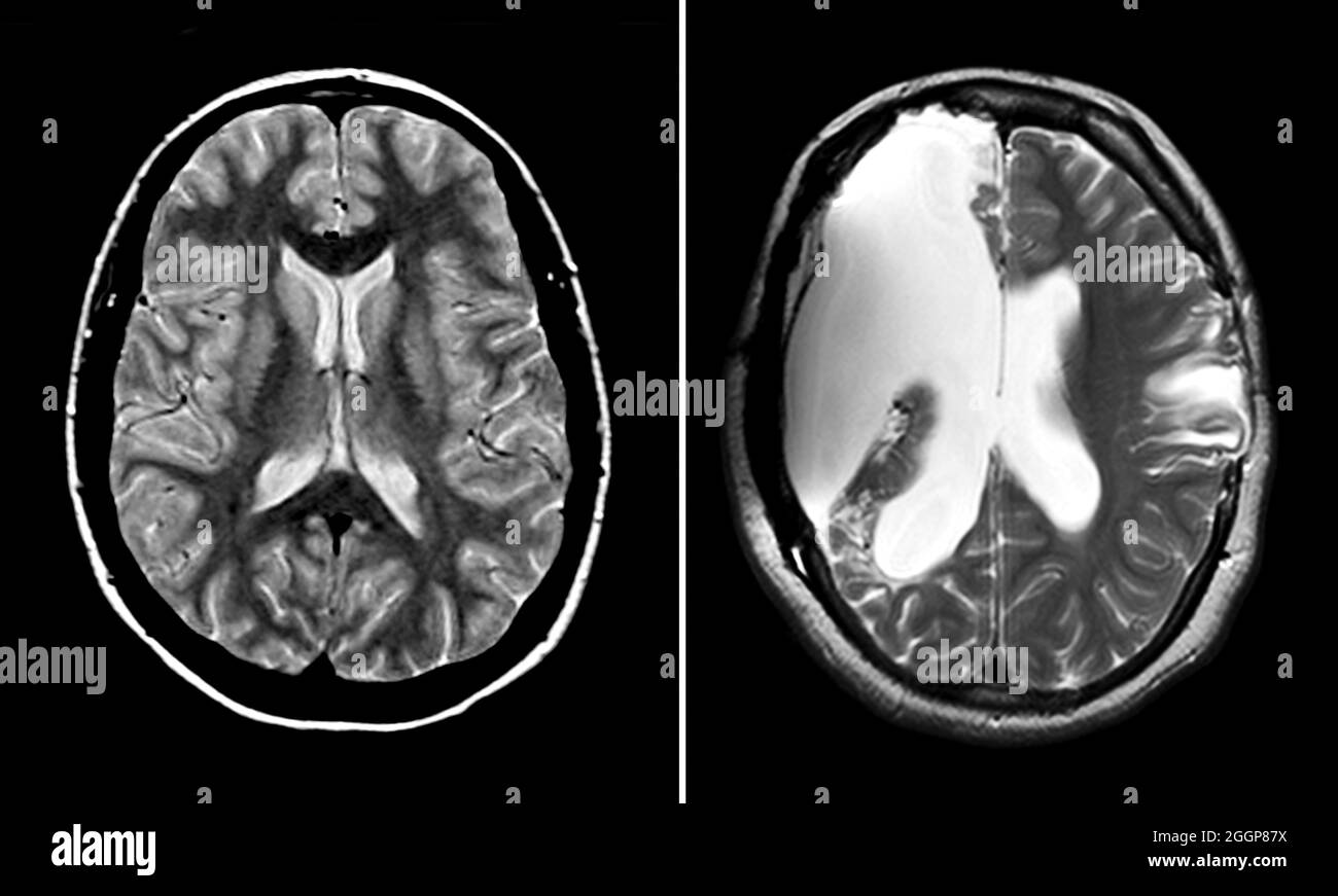 Irm Anormal Du Cerveau Banque d