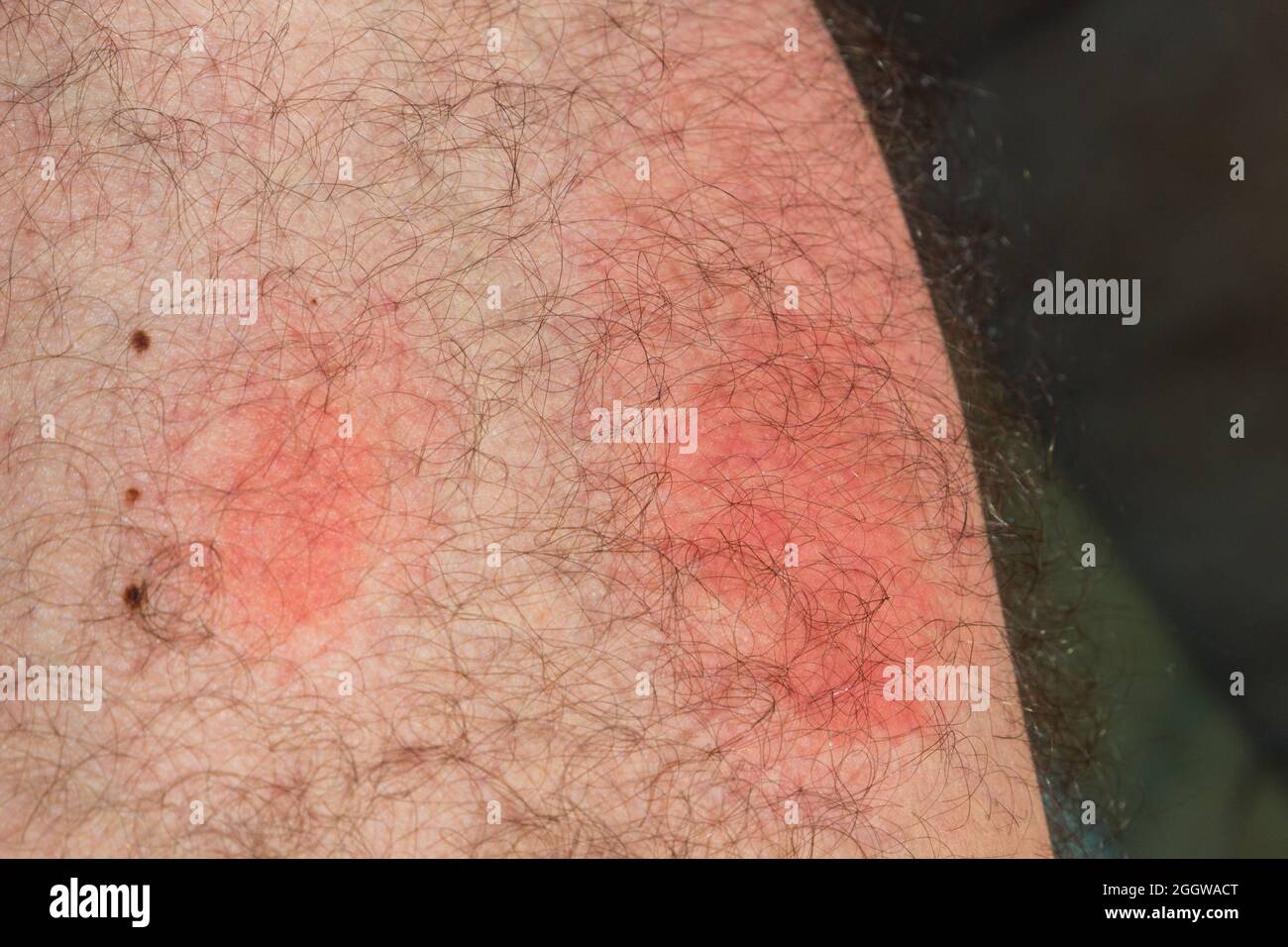 Piqûres de guêpes sur la peau après une journée, des marques d'inflammation rouges causées par des morsures de guêpes Banque D'Images