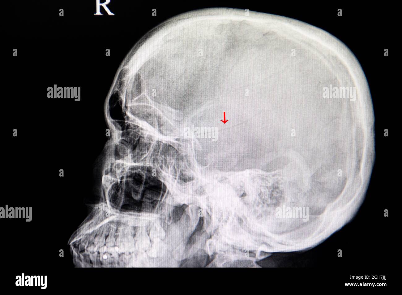 Film radiographique du crâne d'un patient traumatisant présentant une fracture linéaire temporopariétale du crâne. Banque D'Images