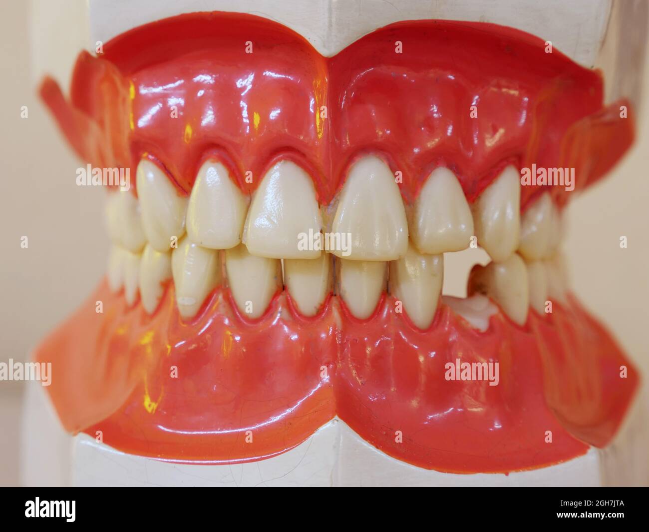 un modèle de dents humaines avec une dent cassée Banque D'Images