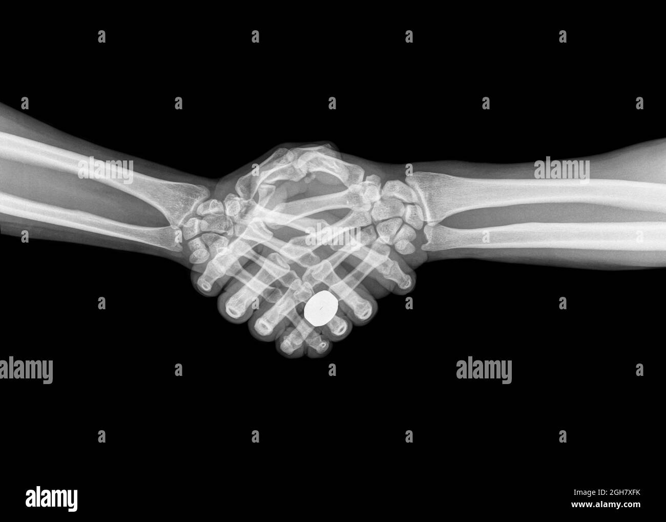 X-ray de deux personnes se serrant la main sur fond noir Banque D'Images
