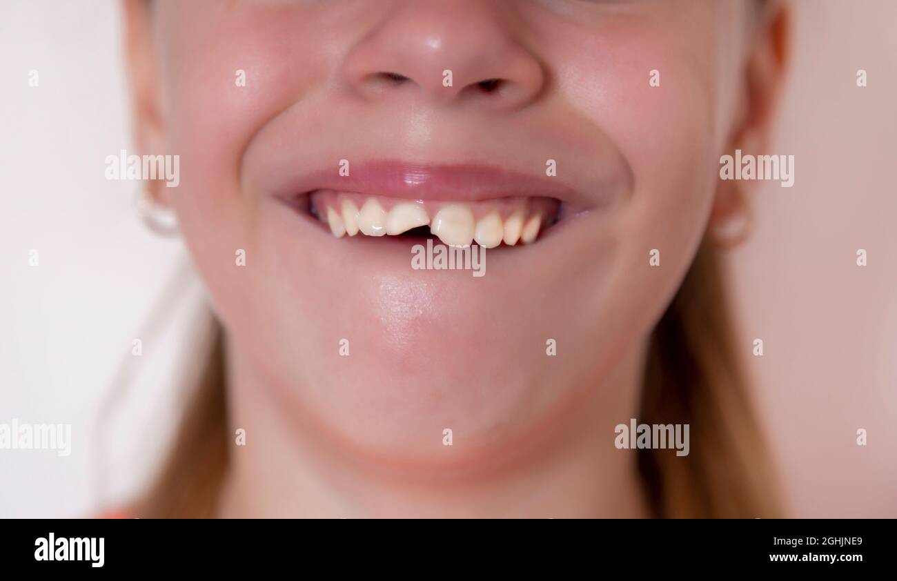 Deux dents femelles avant sont cassées, les dents antérieures sont endommagées. La fille a 11 ans Banque D'Images