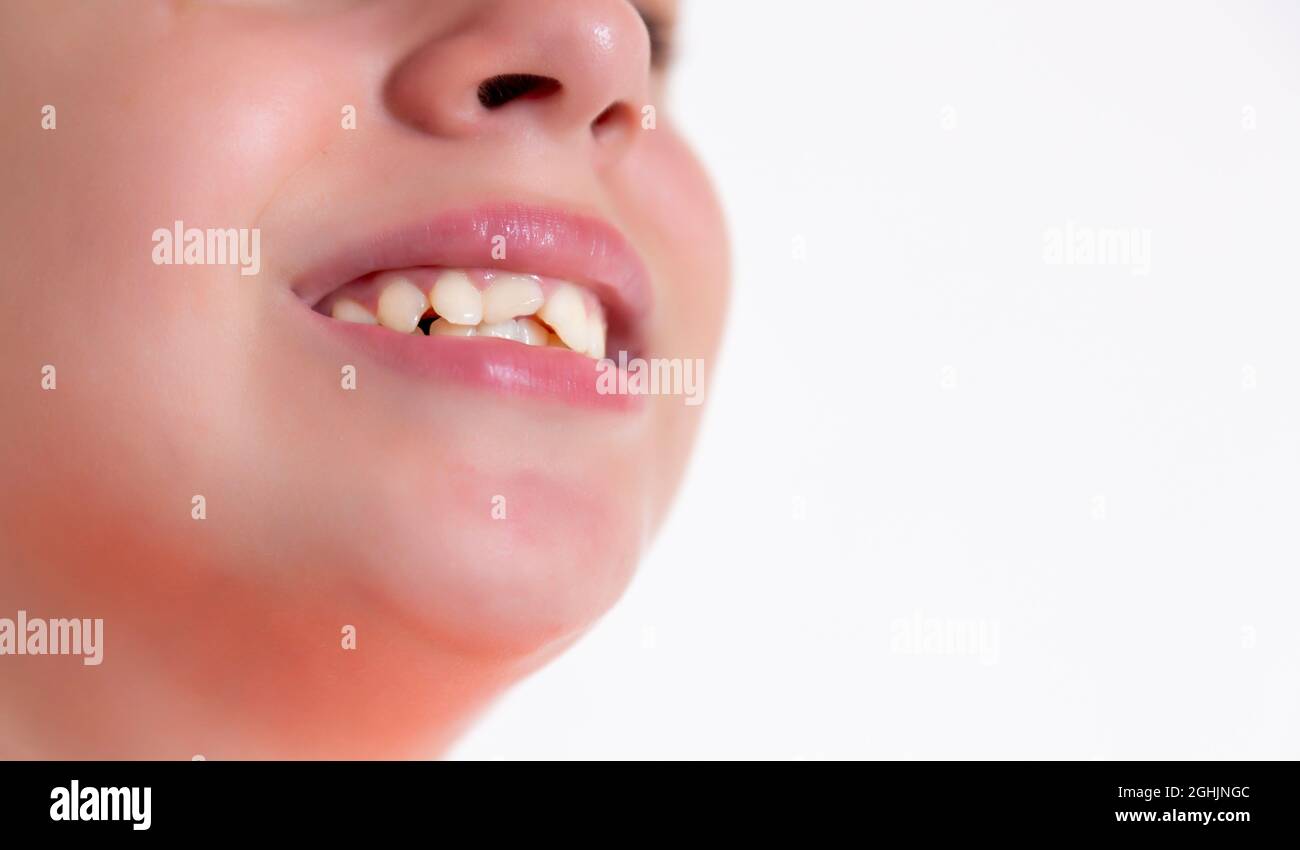 La fille a frappé deux dents sur le devant. Augmentation des dents. Banque D'Images