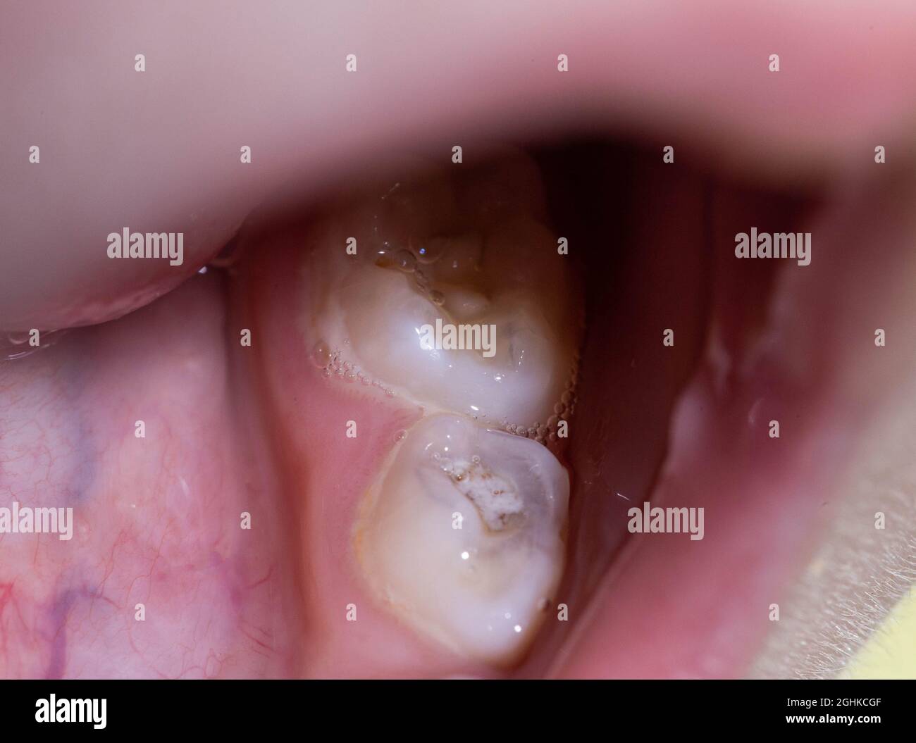 Caries sur la dent d'un bébé, gros plan. Concept de traitement dentaire pour les enfants en dentisterie moderne, macro Banque D'Images