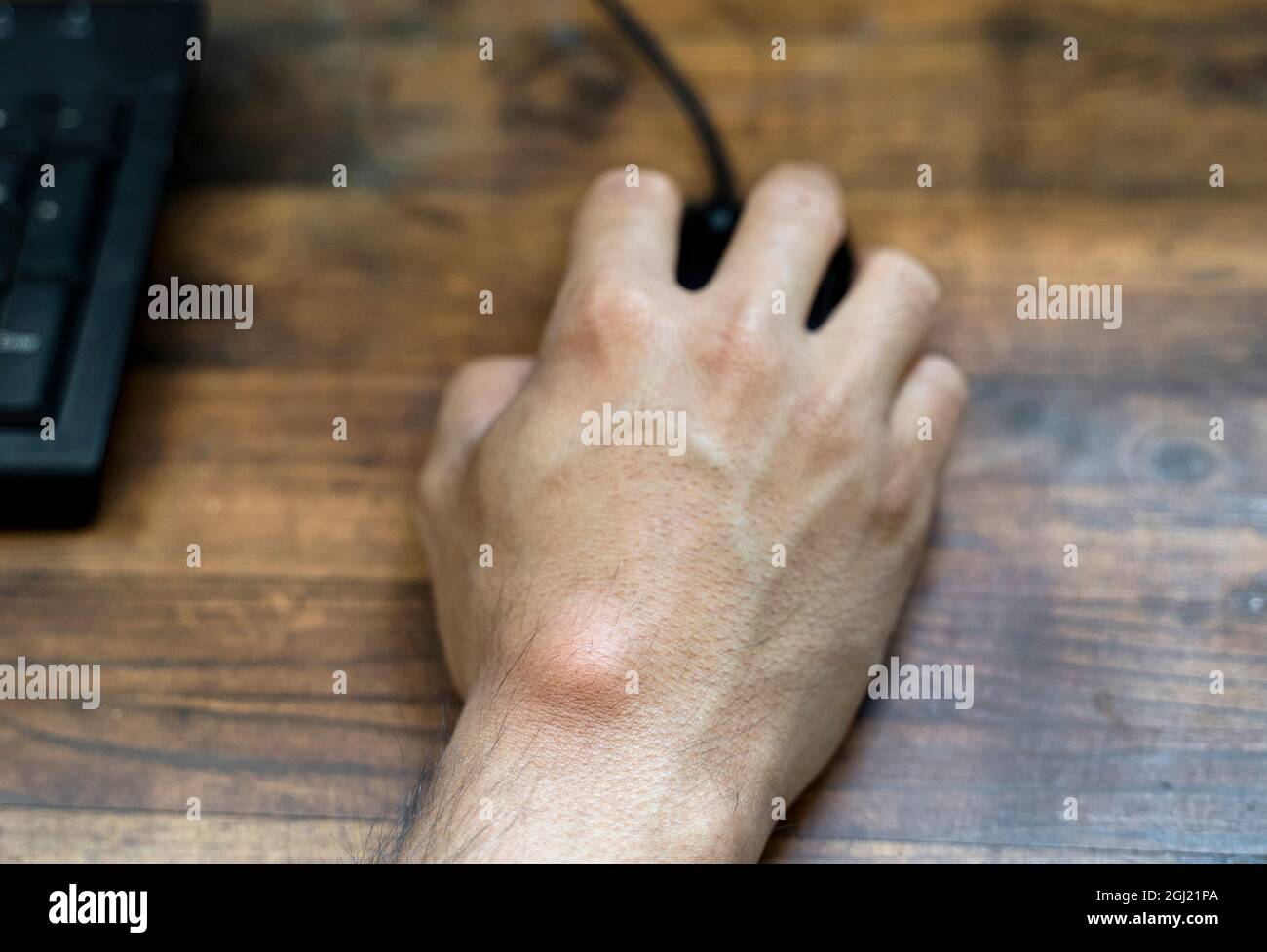 Kyste de ganglion sur la main de l'homme. Main tenant la souris de l'ordinateur. Banque D'Images