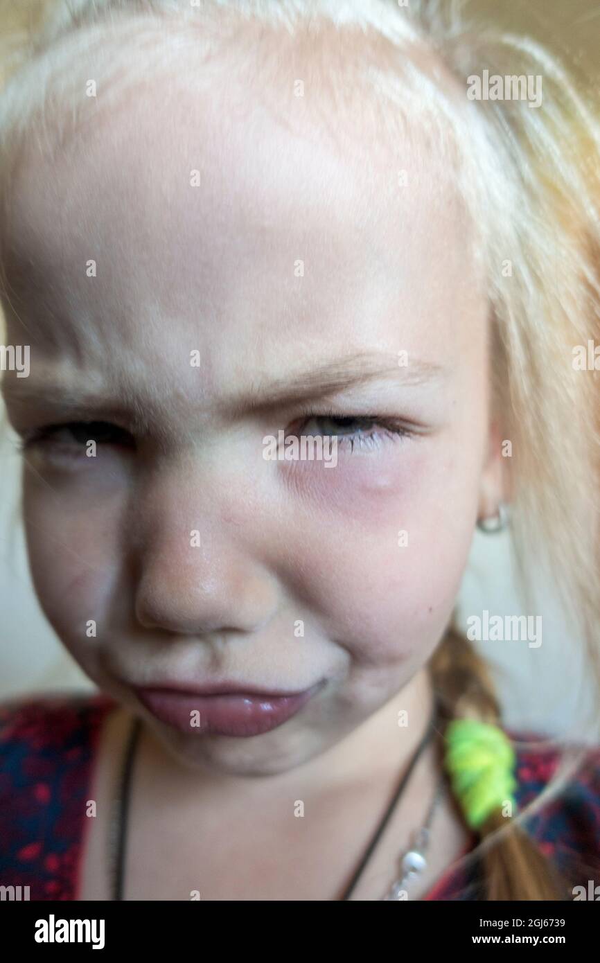 Petite fille bouleversée avec une morsure sous les yeux Banque D'Images
