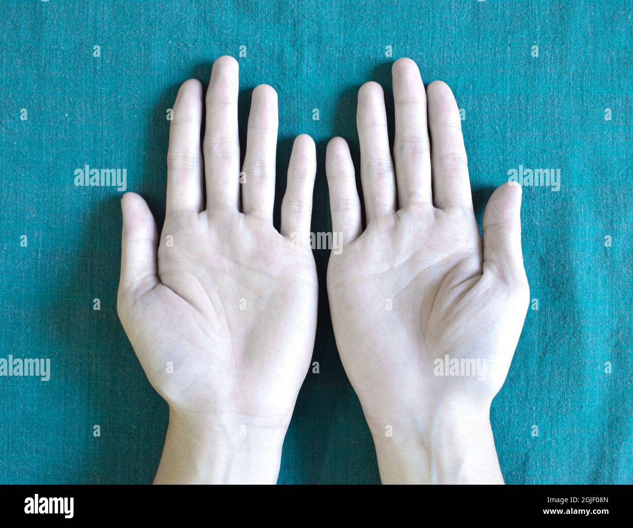 Surface palmaire pâle des deux mains. Les mains anémiques de l'asiatique, de l'homme chinois. Banque D'Images