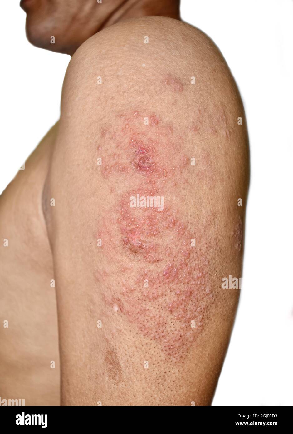 Infection simplex d'herpès au bras de l'homme asiatique. Petites vésicules douloureuses. Isolé sur blanc. Banque D'Images Infection simplex d'herpès au bras de l'homme asiatique. Petites vésicules douloureuses. Isolé sur blanc. Banque D'Images