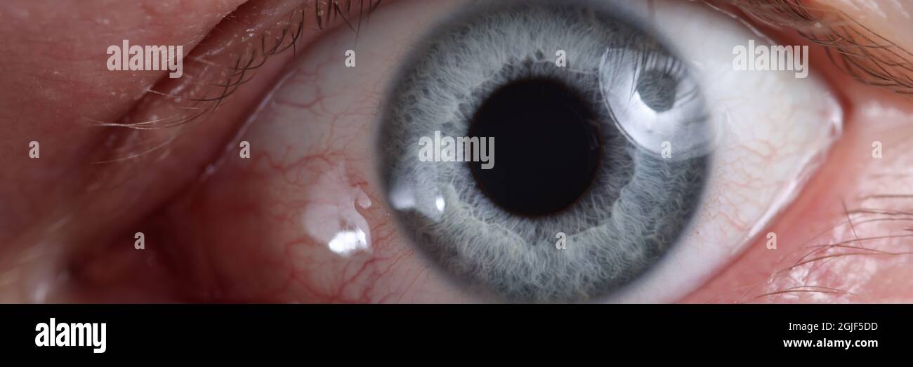 Gros plan de l'œil malade avec des vaisseaux rouges dilatés Banque D'Images