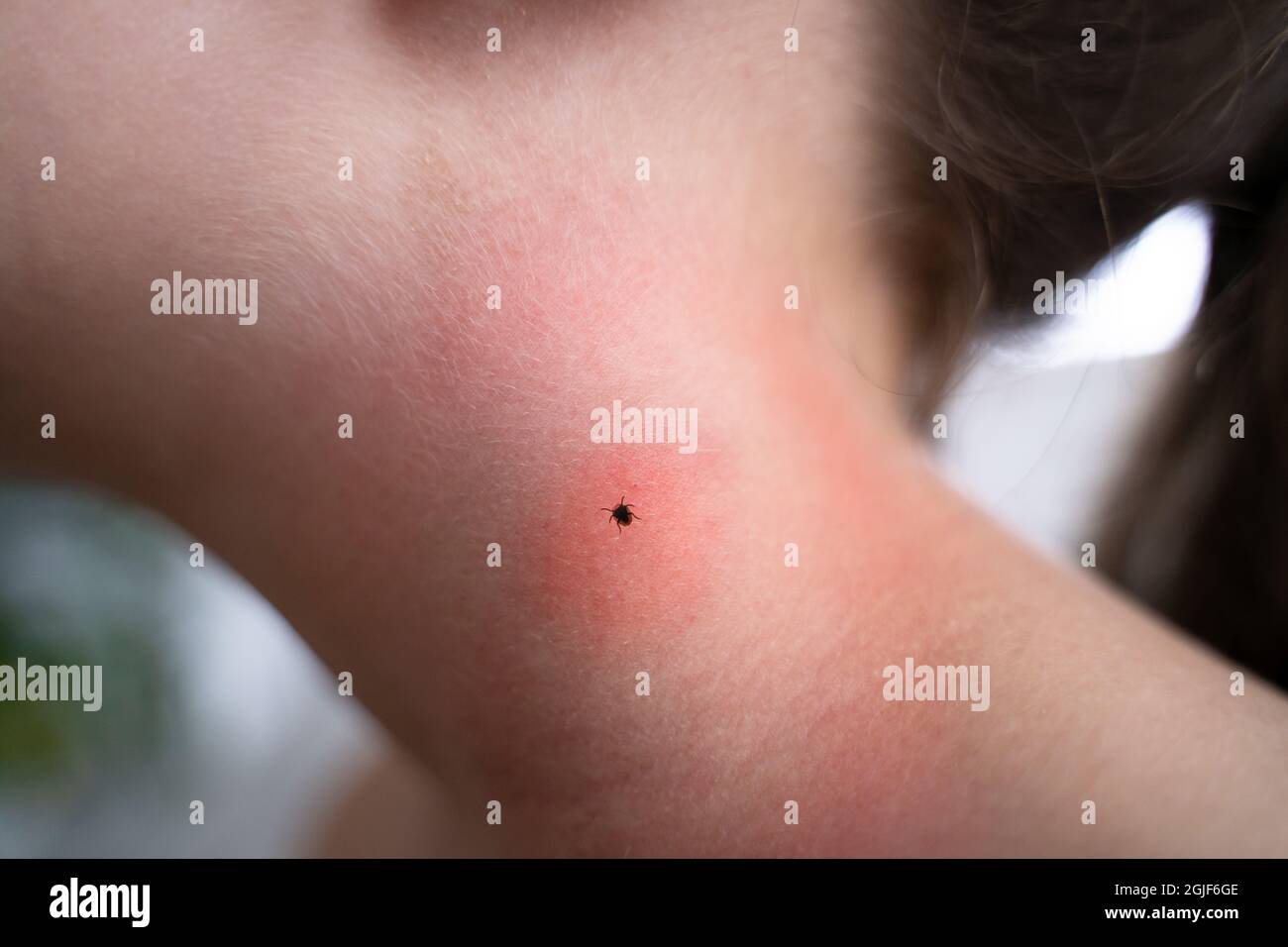 Encéphalite insecte ou parasite arachnide sous la peau de l'enfant Banque D'Images