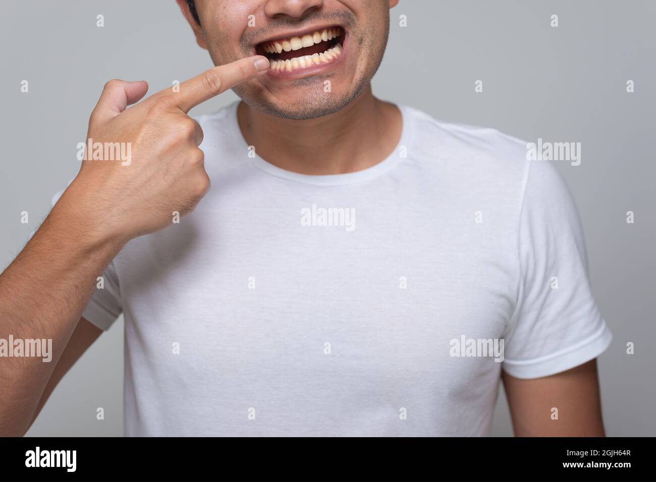 Homme mexicain à l'apparence hispanique avec des dents jaunes, jeune homme à cheveux chinois en chemise blanche avec arrière-plan gris, pointe son doigt vers sa bouche Banque D'Images