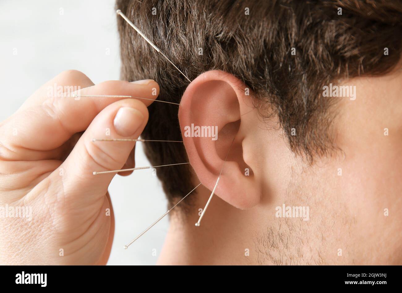 L'oreille de l'homme avec des aiguilles, libre. Concept d'Acupuncture Photo  Stock - Alamy
