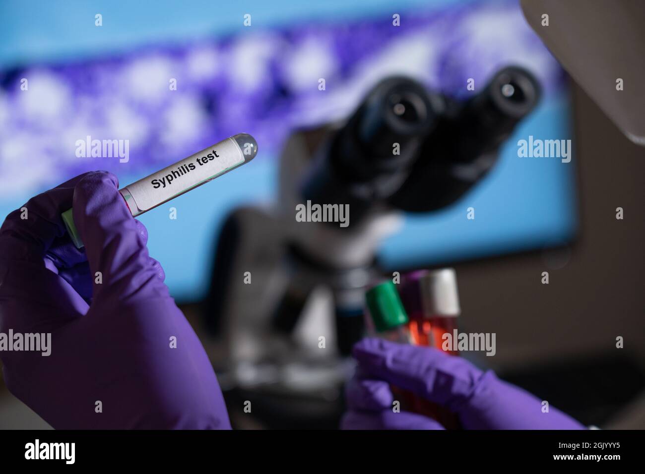 Test sanguin pour la syphilis causée par la bactérie treponema pallidum ou treponema pâle. Cette infection est transmise sexuellement. Banque D'Images