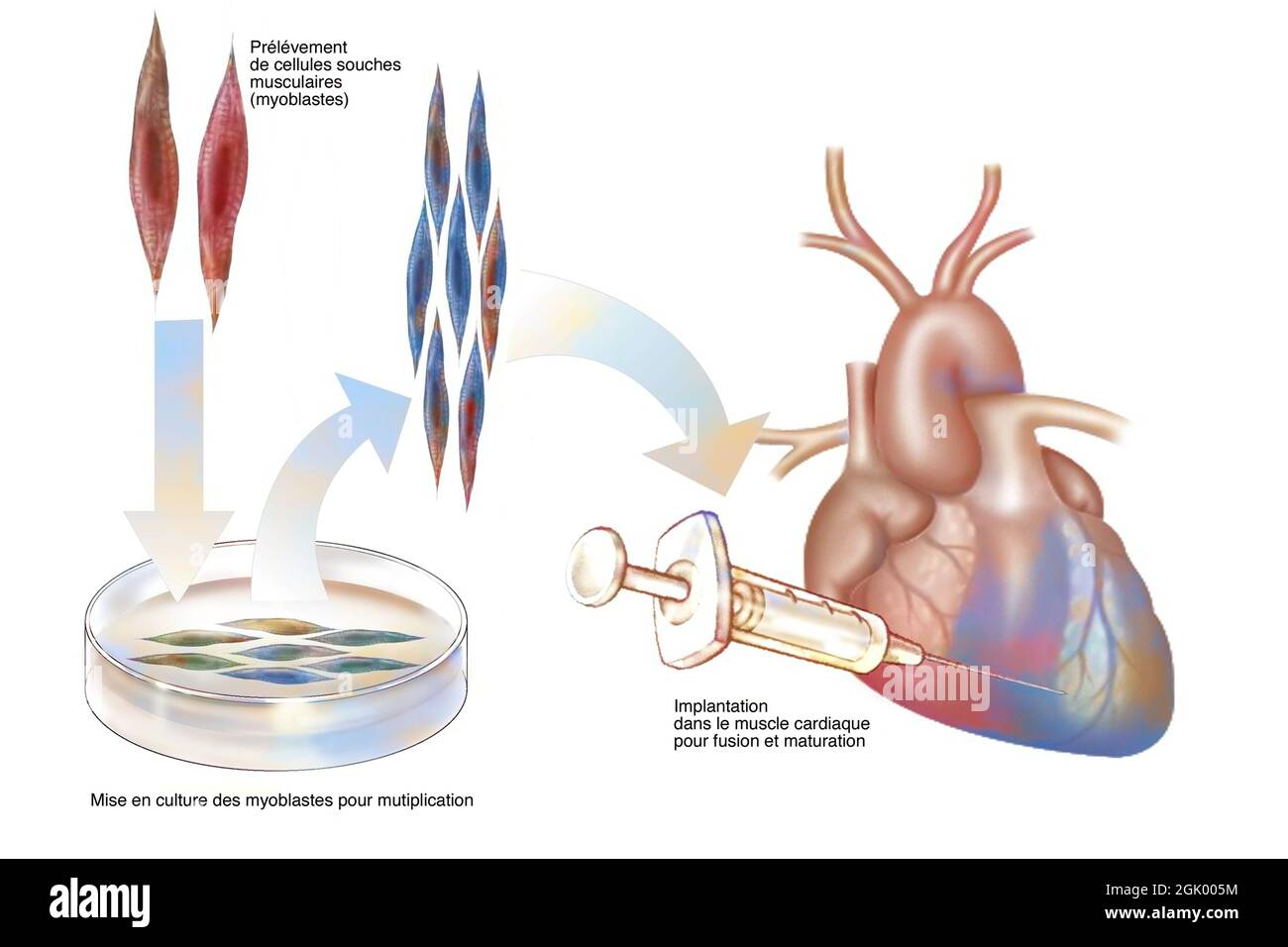 Culture de cellules souches musculaires pour implantation dans le muscle cardiaque. Banque D'Images