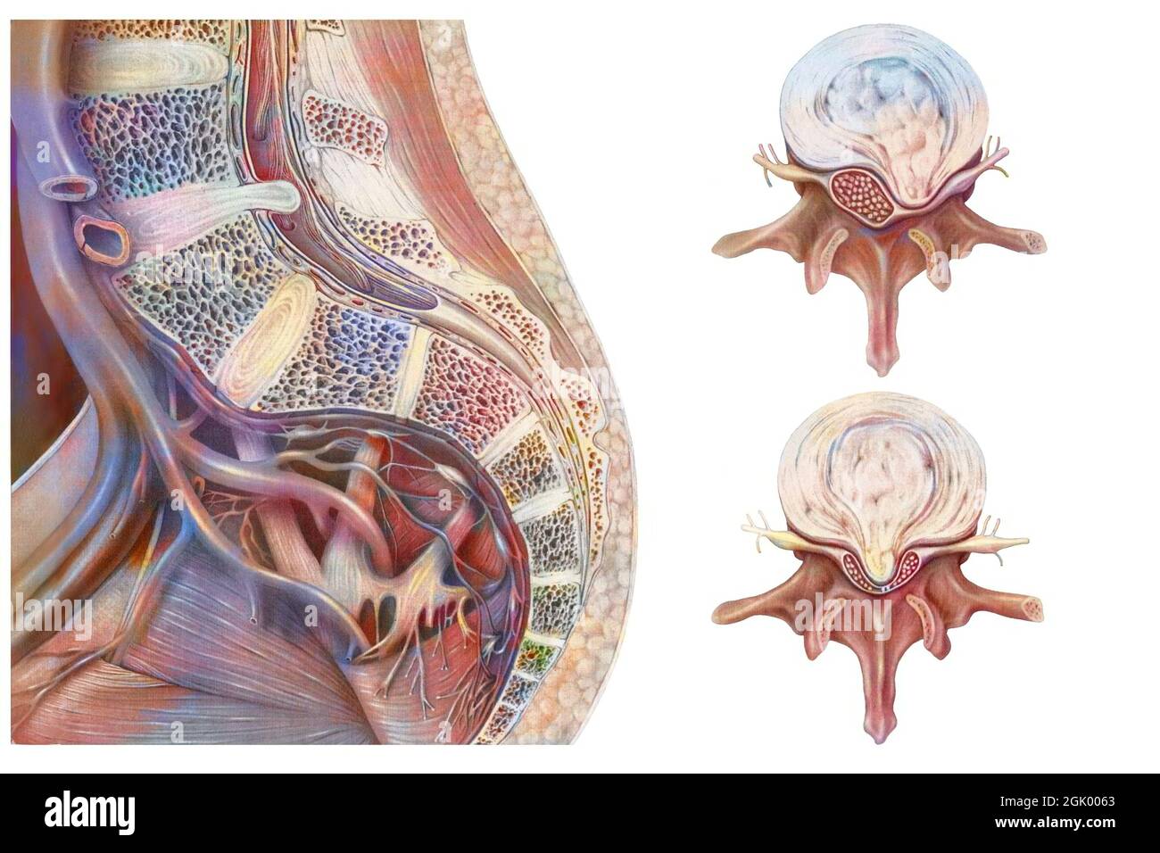 Un disque hernié est une protrusion anormale d'un disque intervertébral. Banque D'Images