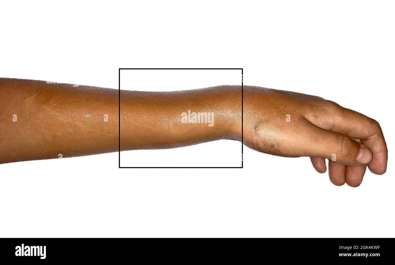 La fracture des colles est une fracture complète de l'os de rayon de l'avant-bras près du poignet. Poignet cassé. Banque D'Images