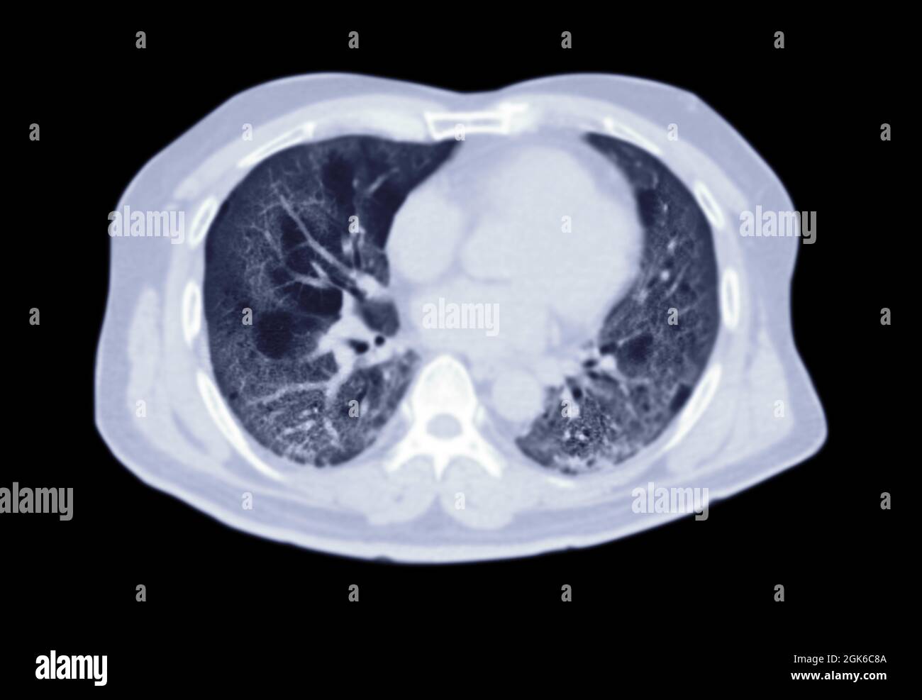 Acquisition CT de la vue axiale du thorax ou du poumon de l'infection pulmonaire Covid-19 avec opacité de verre rodé isolée sur fond noir. Masque. Banque D'Images