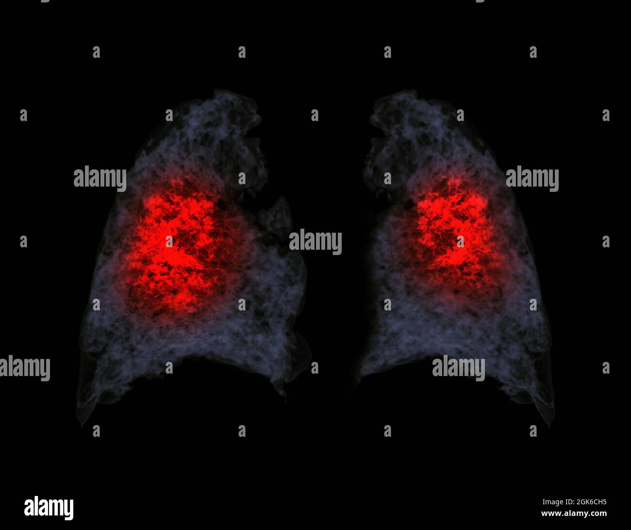 Rendu 3d CT du thorax montrant une infection pulmonaire due à Covid-19. Banque D'Images