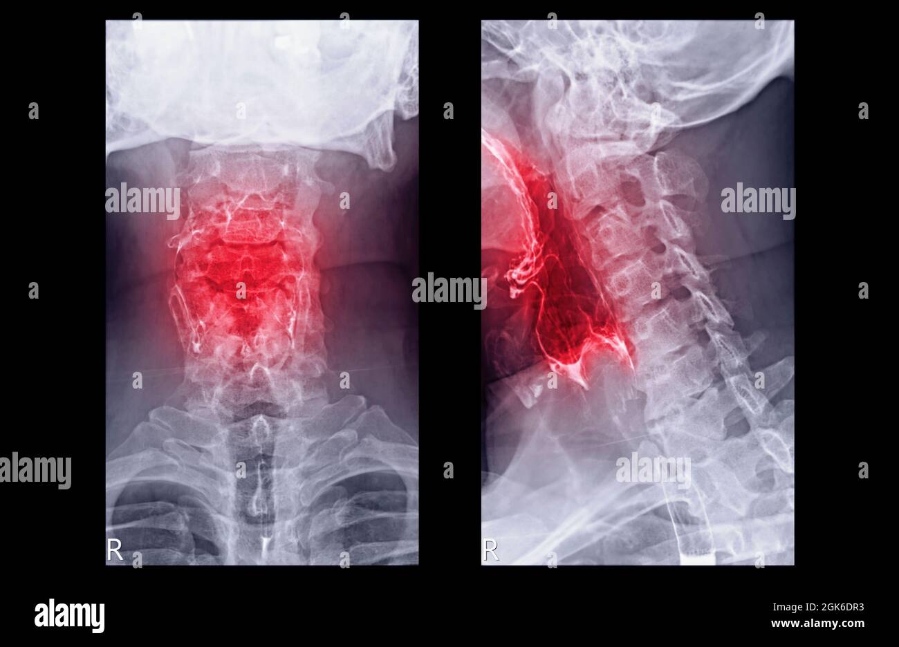 Vue AP et latérale de l'hirondelle d'ésophagramme ou de baryum montrant l'œsophage pour le diagnostic de RGO ou de reflux gastro-oesophagien et de cancer de l'œsophage. Banque D'Images