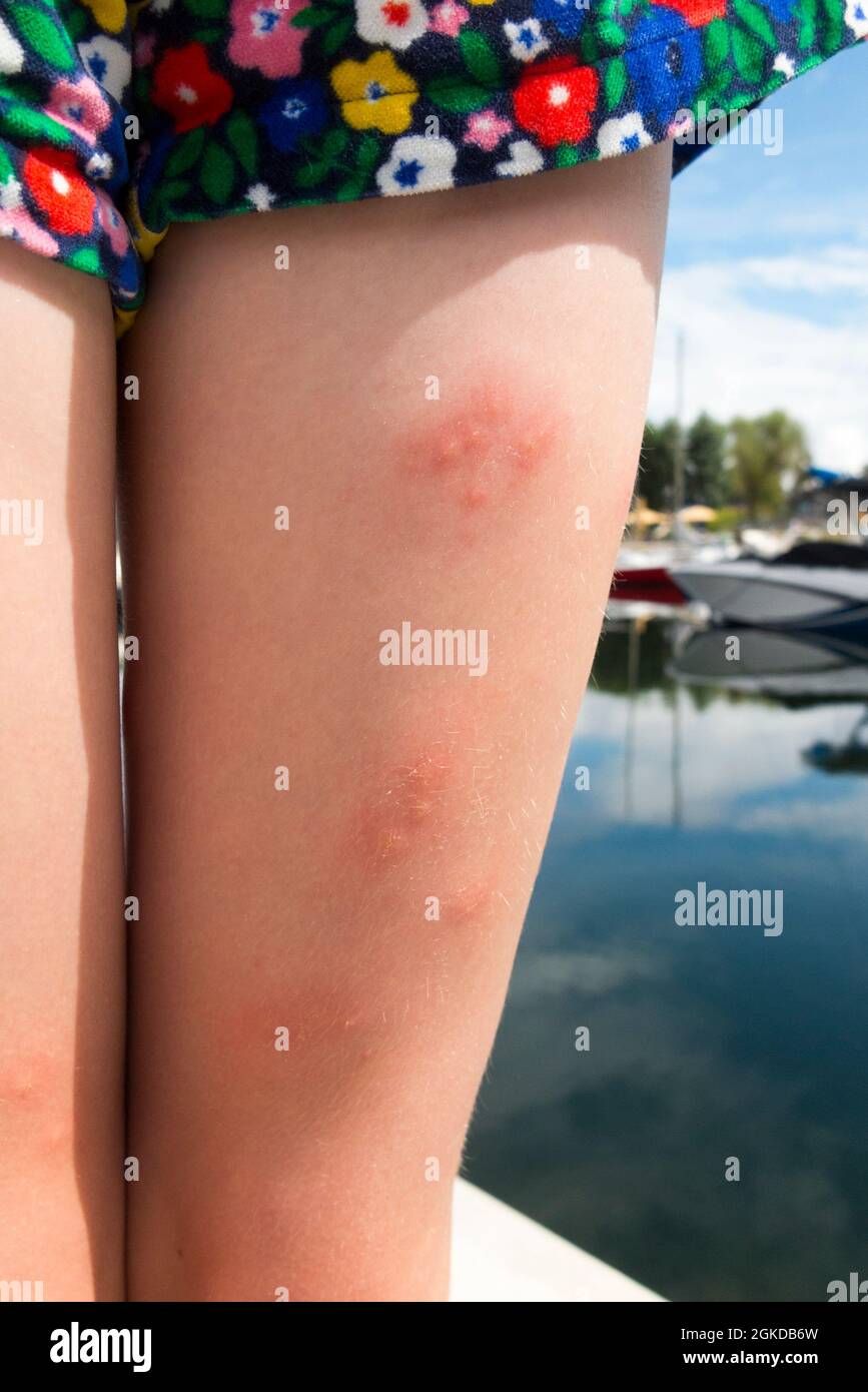 Piqures De Puces Banque D Image Et Photos Alamy