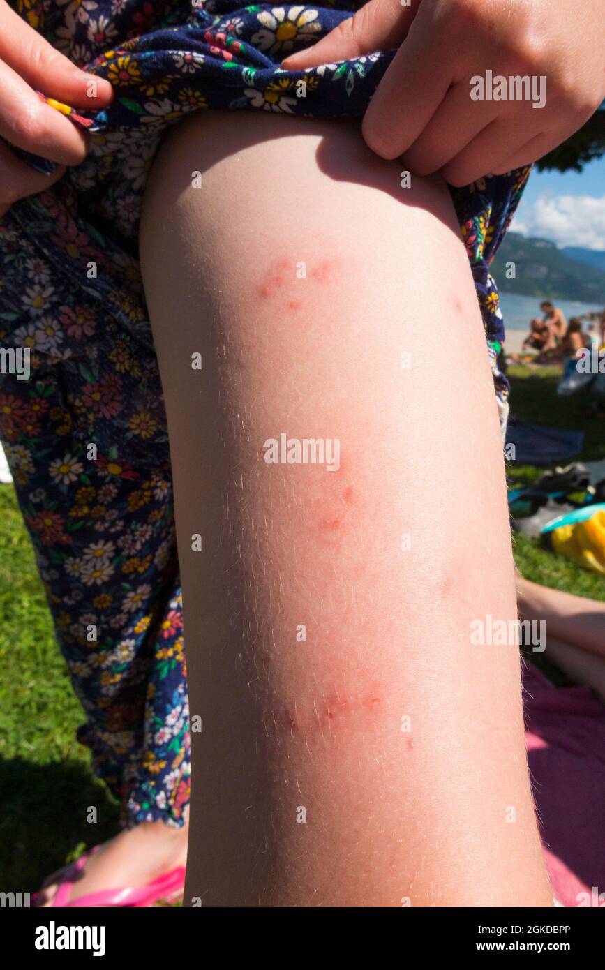 Piqure De Puce Banque D Image Et Photos Alamy