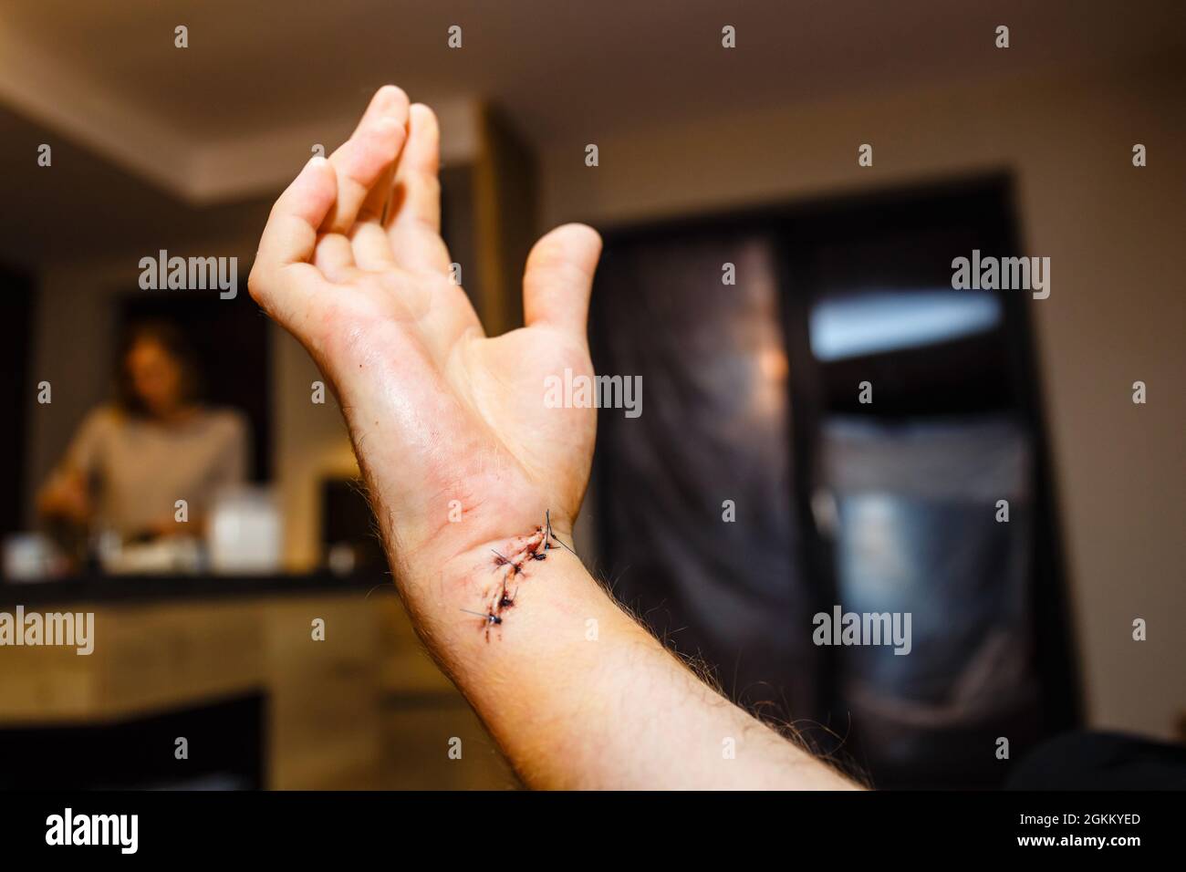 cicatrice fraîche sur le poignet après la chirurgie du tendon et du nerf Banque D'Images