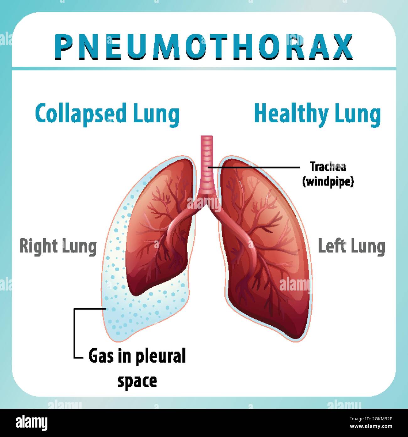 Schéma pneumothorax avec poumon collabé et poumon sain Illustration de Vecteur