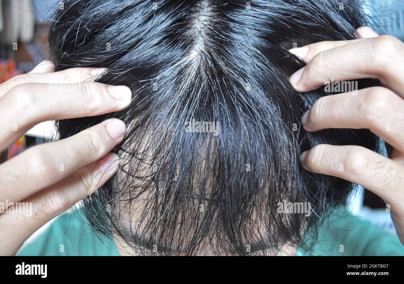 Blanchiment prématuré des cheveux. Vieillissement précoce. Changements de couleur grise des cheveux chez le jeune homme asiatique. Banque D'Images