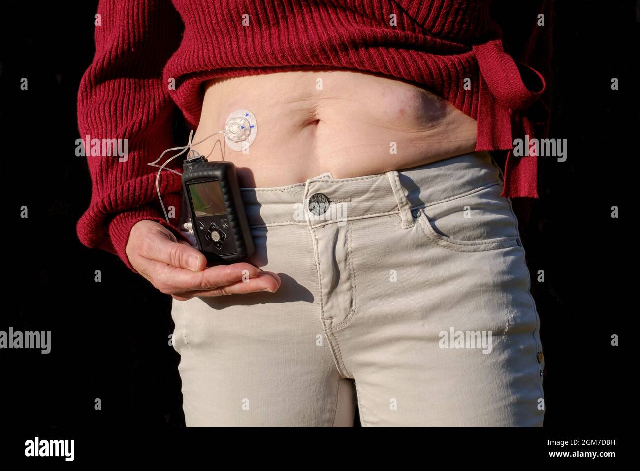 femme portant une pompe à insuline mobile medtronic pour son diabète Banque D'Images