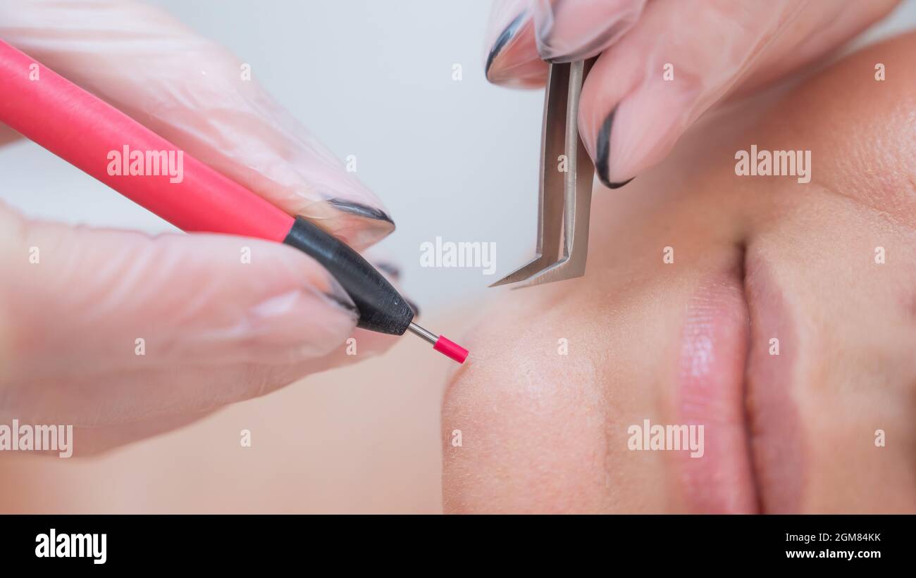 Femme sur l'épilation électrique du visage. Matériel élimination permanente  des poils indésirables sur le menton Photo Stock - Alamy