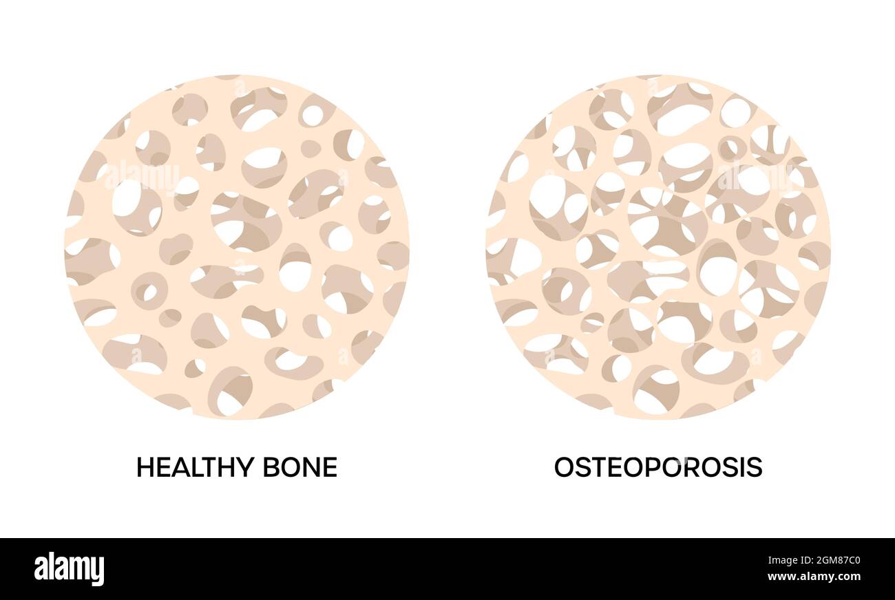 Tissu osseux endommagé par l'ostéoporose, par rapport aux os sains humains. Structure spongieuse du squelette normale et éclaircie, illustration vectorielle Illustration de Vecteur