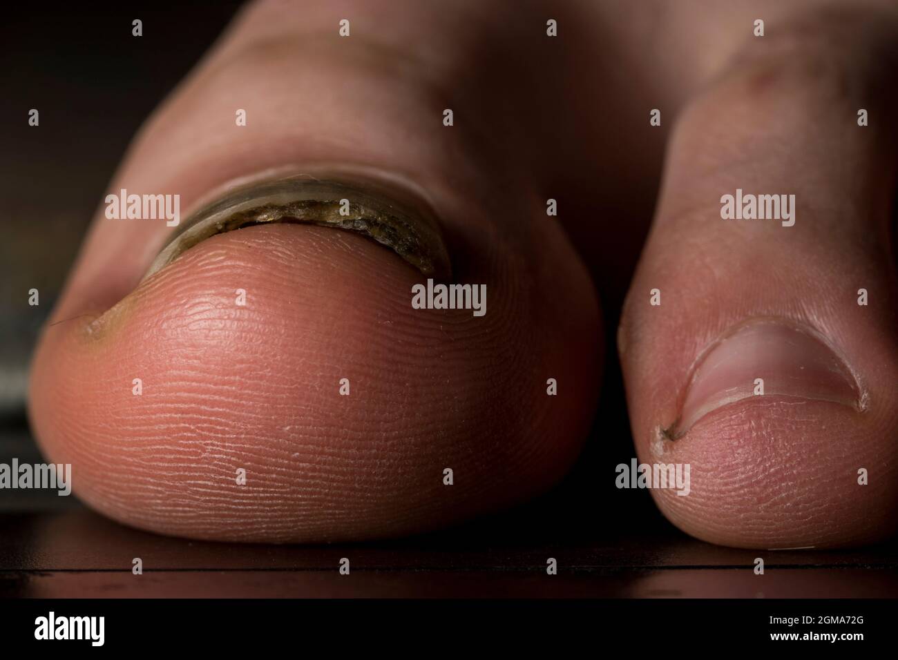 Mycose Des Ongles Banque D Image Et Photos Alamy Mycose Des Ongles Banque D Image Et Photos Alamy