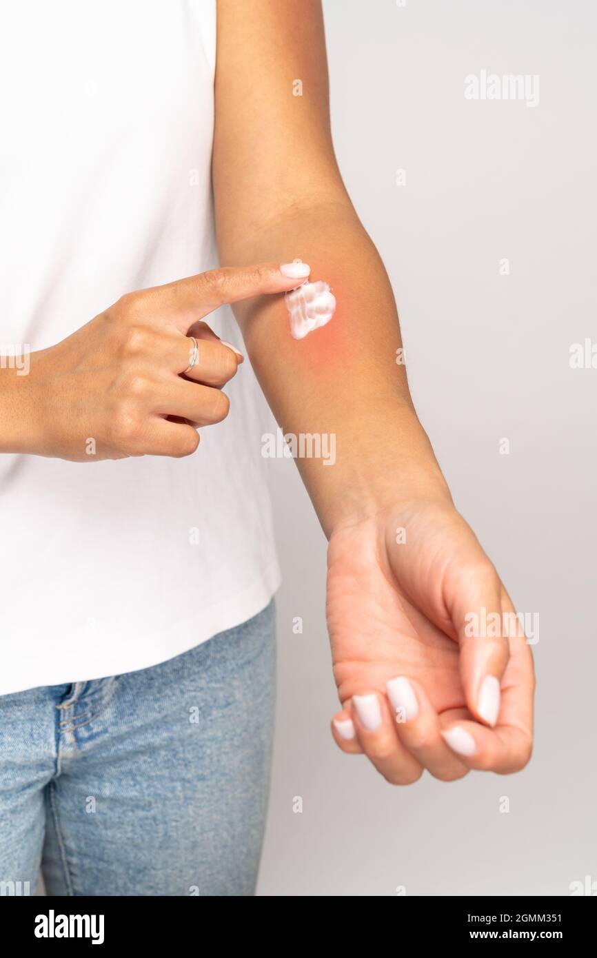 Femelle appliquant de la crème sur la peau de houle après des piqûres d'insectes, isolé sur fond gris studio. Allergie. Banque D'Images
