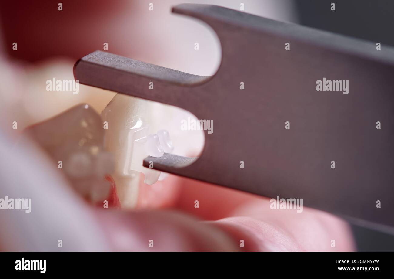Gros plan de l'orthodontiste à l'aide d'une jauge de support en aluminium tout en fixant les bretelles aux dents du patient. Personne avec des supports sur les dents ayant une procédure dentaire. Concept de stomatologie, traitement orthodontique Banque D'Images