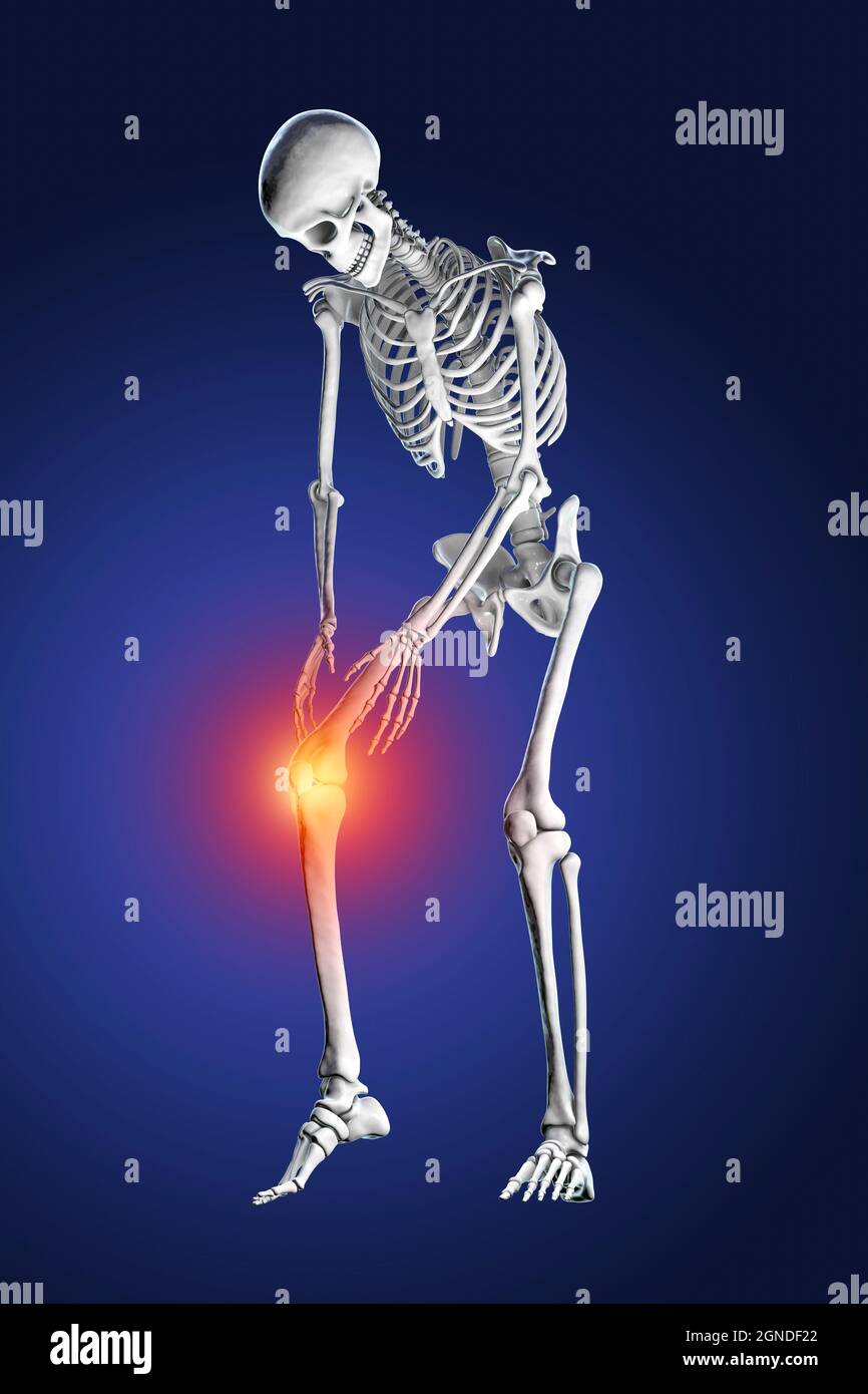 Les douleurs au genou, illustration Banque D'Images