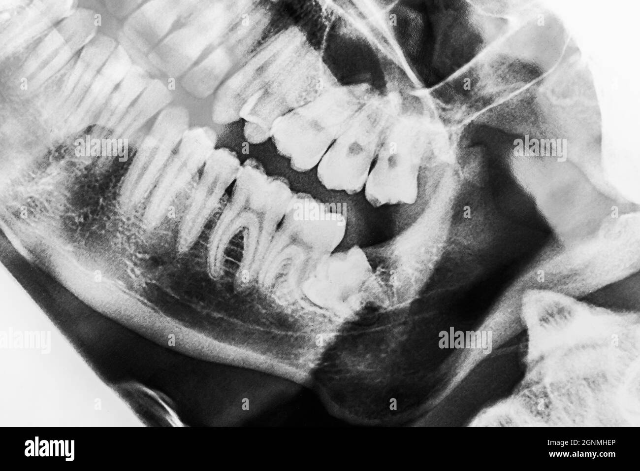 Image de la dentisterie de sagesse dentaire à rayons X. Banque D'Images