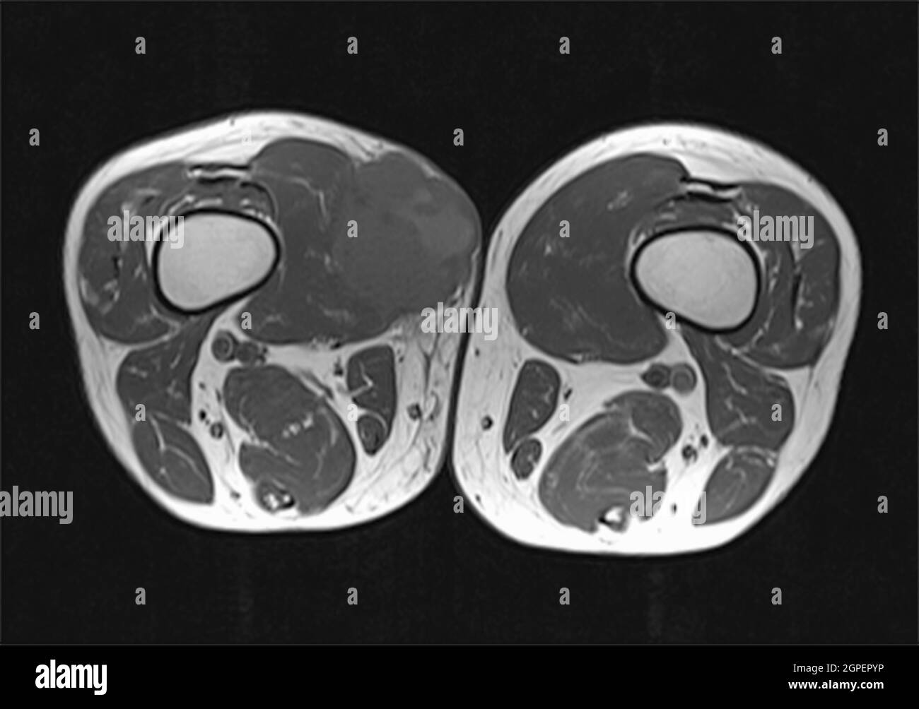 IRM d'une tumeur maligne (sarcome) sur la cuisse droite d'un patient adulte de sexe masculin, acquise par imagerie par résonance magnétique (IRM) Banque D'Images