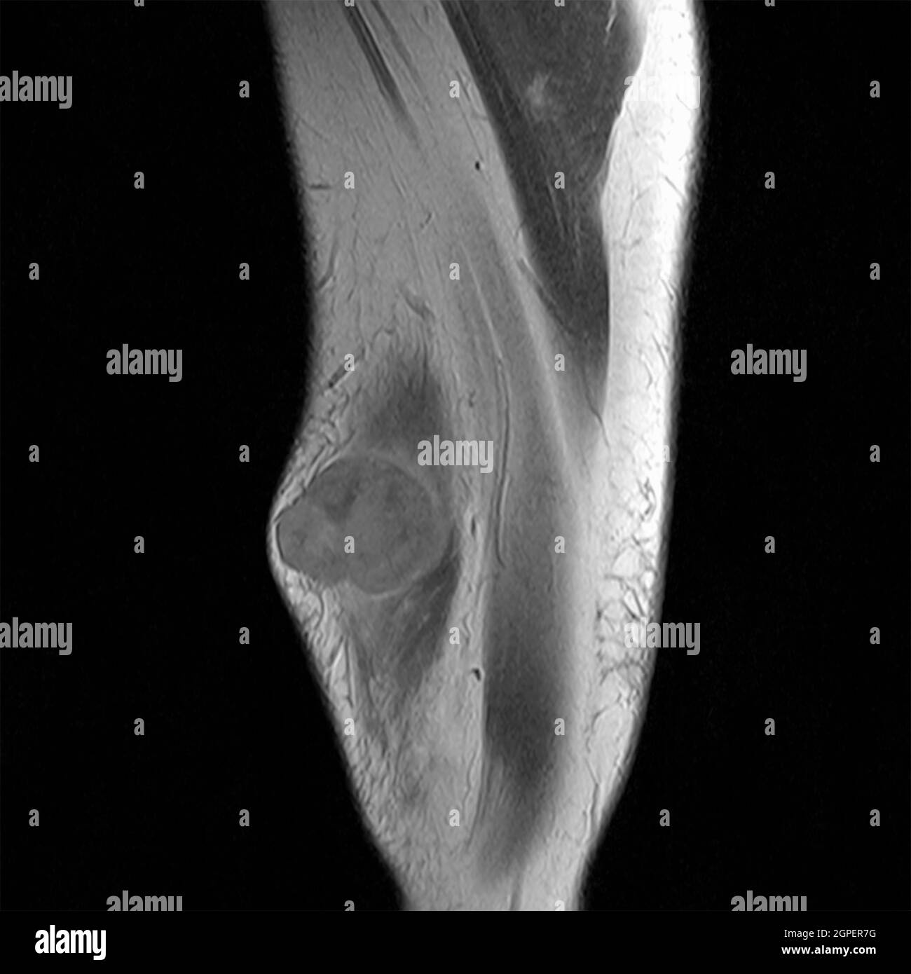 L'imagerie par résonance magnétique (IRM) d'une tumeur maligne (Kaposi) sur la cuisse droite d'un patient de sexe masculin Banque D'Images
