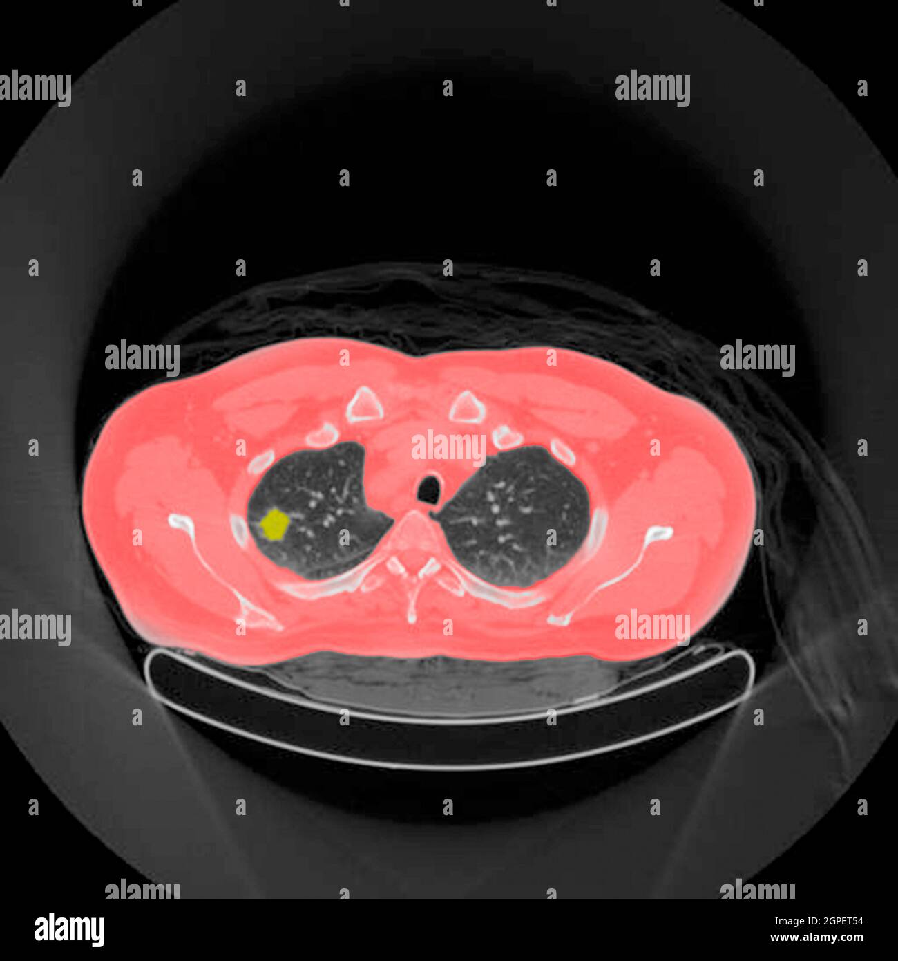 Tomographie par émission de positrons (TEP) d'un patient de 54 ans, de sexe masculin. Une tumeur peut être vue dans le lobe supérieur gauche de ses poumons Banque D'Images