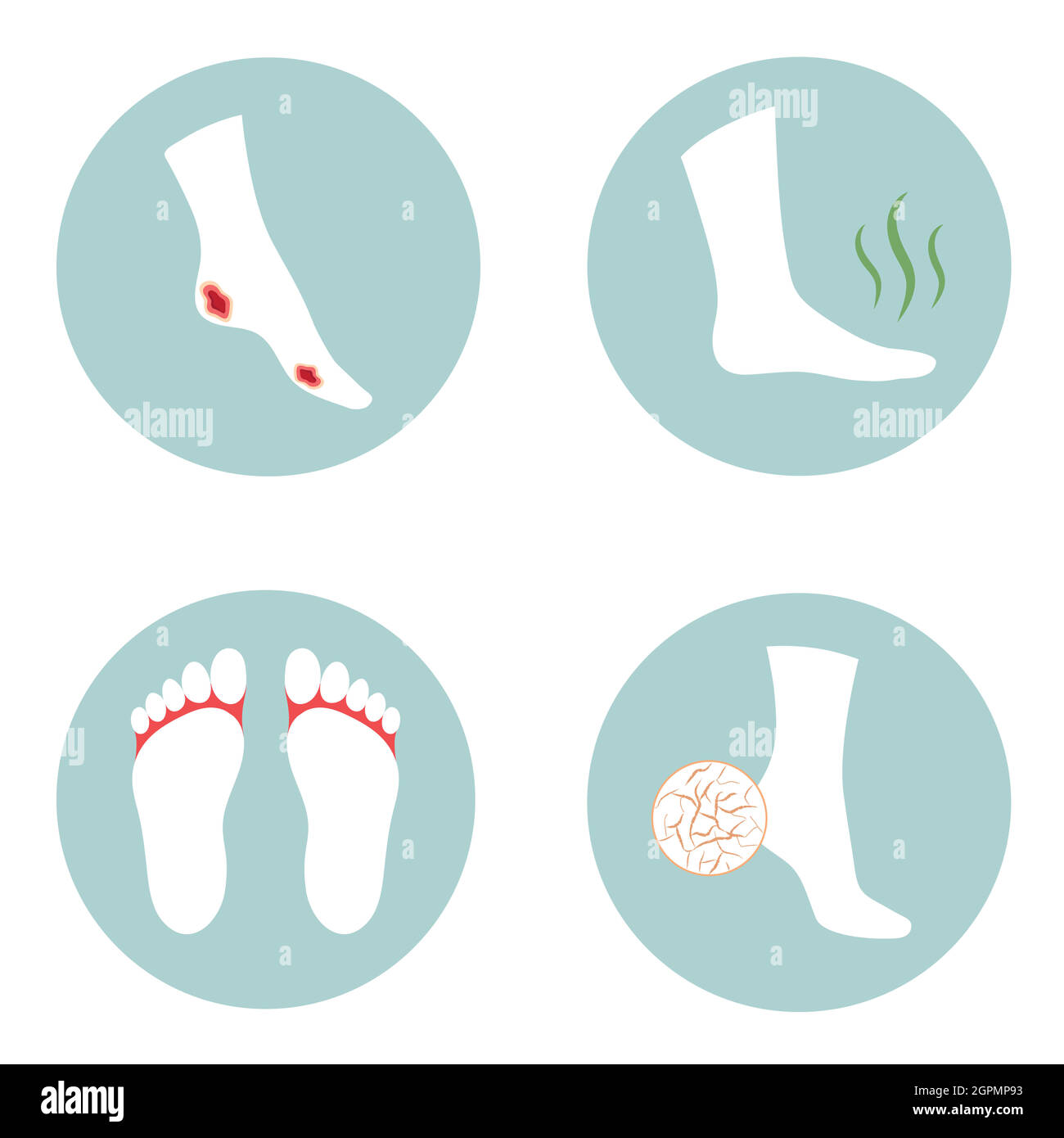 problèmes dibeux, creckés, de champignon et de pied stinky Illustration de Vecteur