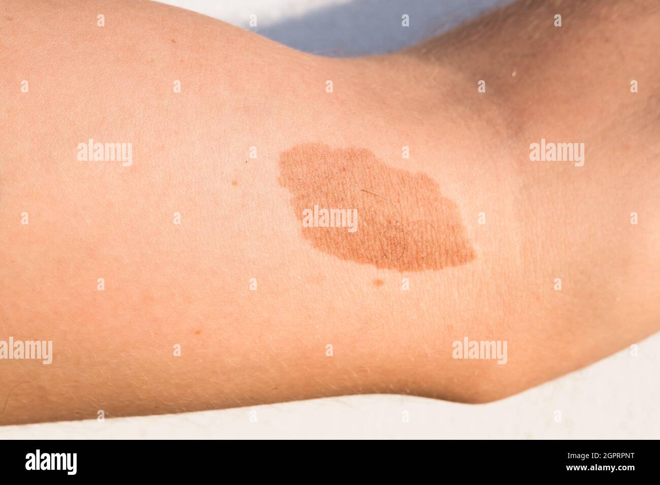 Tache brune peau sur la jambe Banque de photographies et d’images à