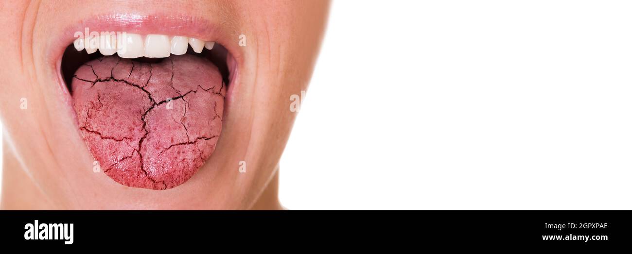 Douleur et fissures de la langue sèche. Candidose orale Banque D'Images