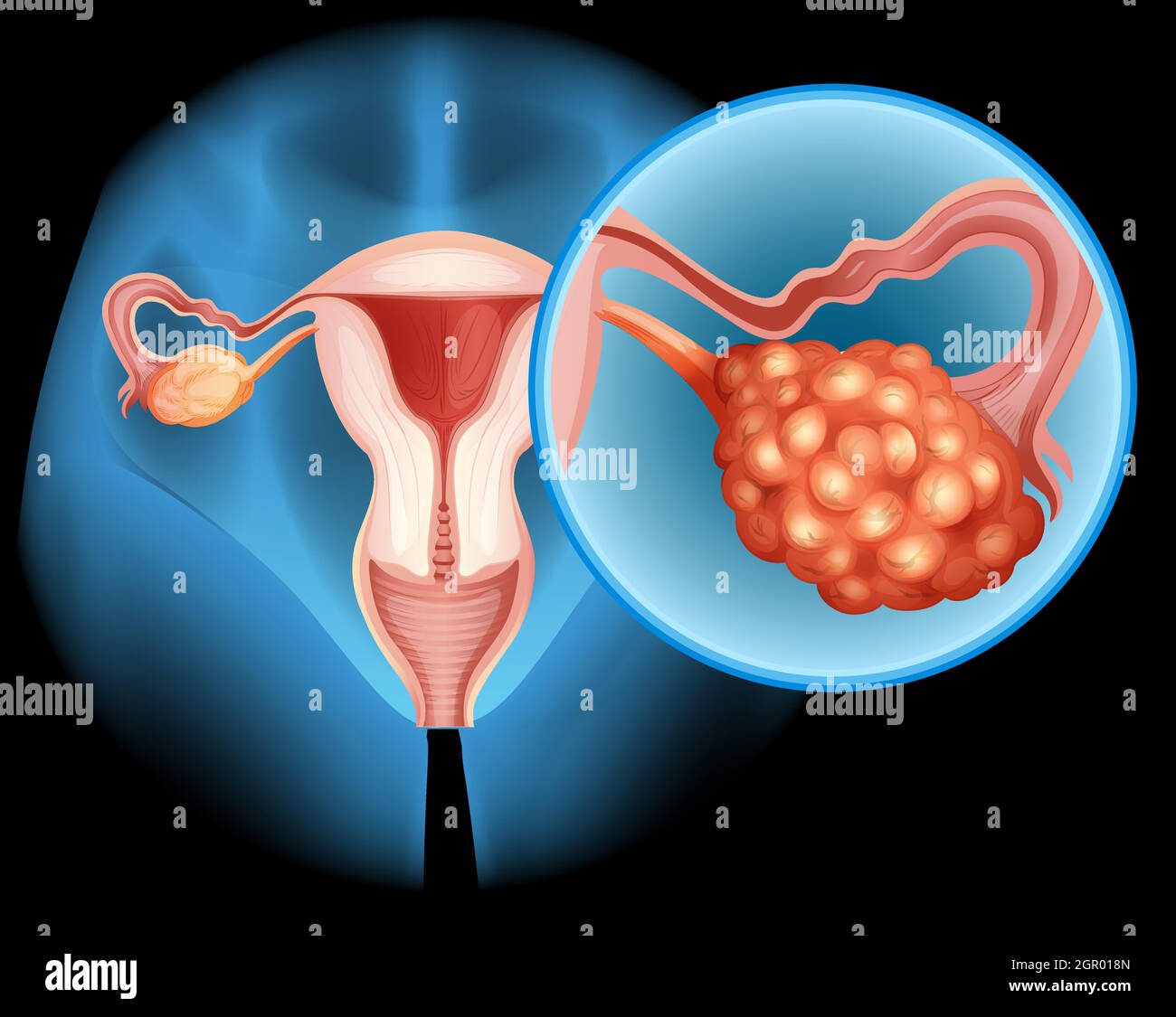 Schéma du cancer de l'ovaire en détail Illustration de Vecteur