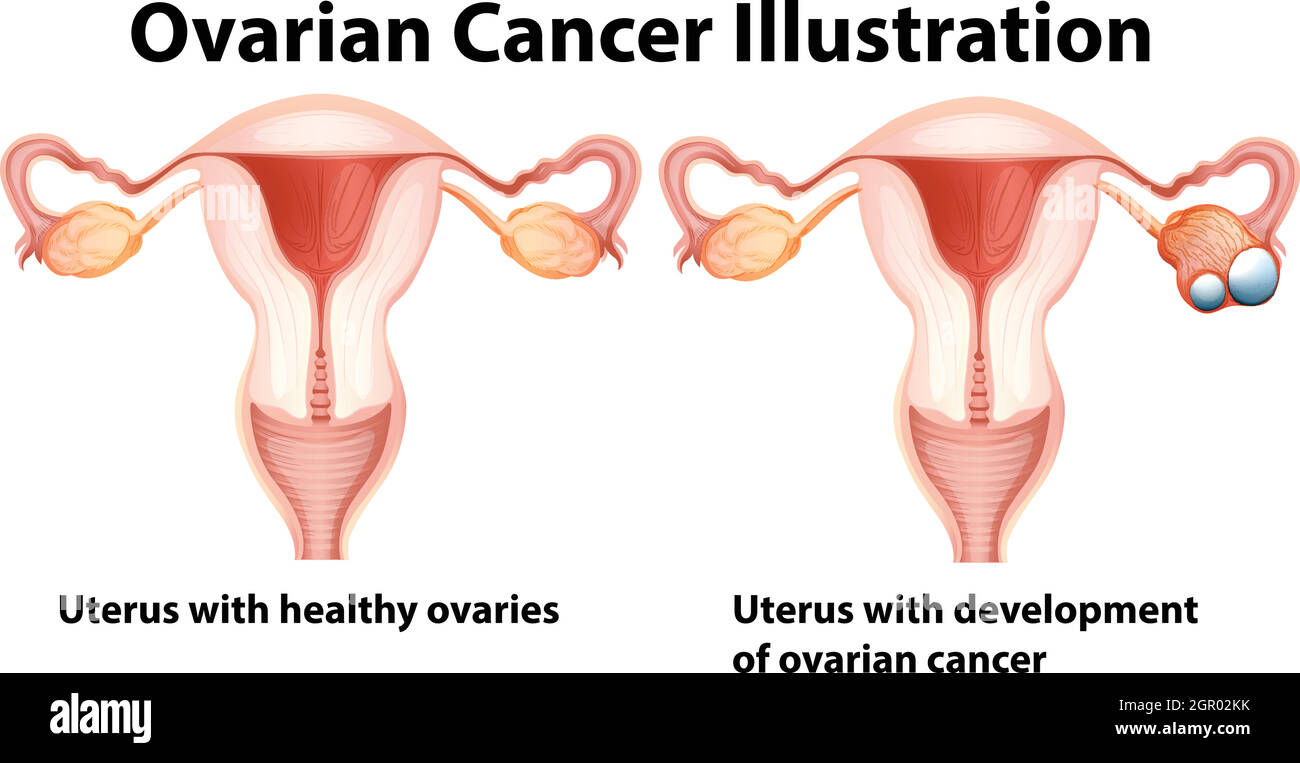 Ovaires sains et malsains chez la femme Illustration de Vecteur