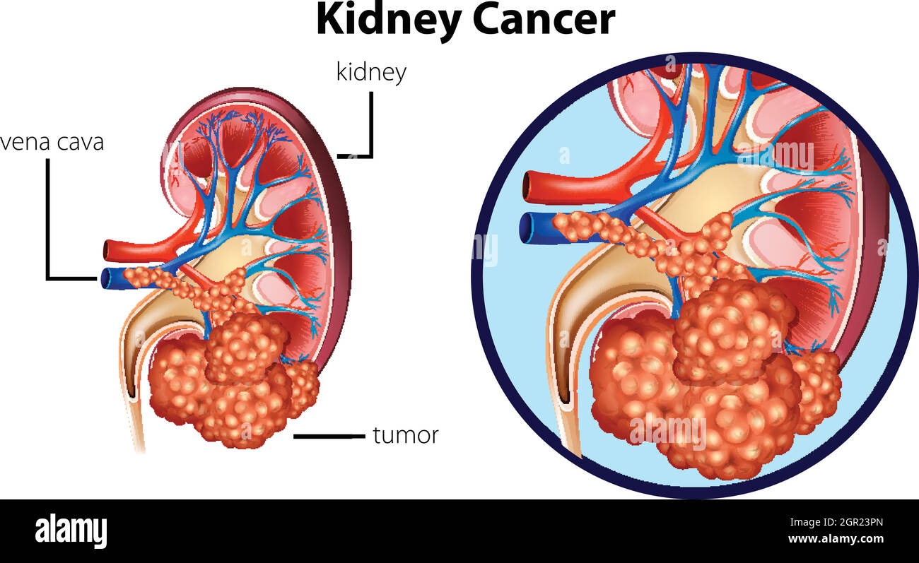 Schéma montrant le cancer du rein Illustration de Vecteur