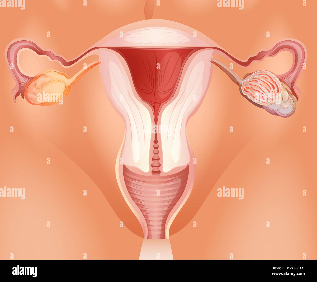 Tumeur ovarienne chez la femme Illustration de Vecteur