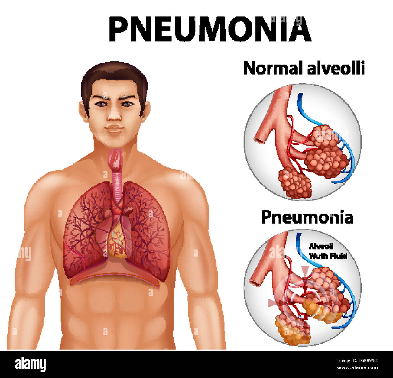Comparaison d'alvéoles saines et de pneumonie Illustration de Vecteur
